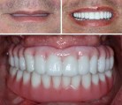 implant-fixed-dentures-1