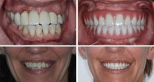 implant-supported-dentures-3