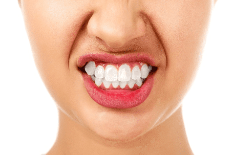 Bruxism Treatment San Jose CA Bruxism Treatment San Jose CA