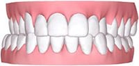 crossbiteinvisalign2