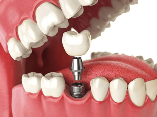 dental-implants-details