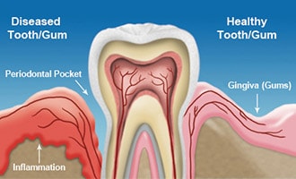 Gum Disease Therapy Bay Area
