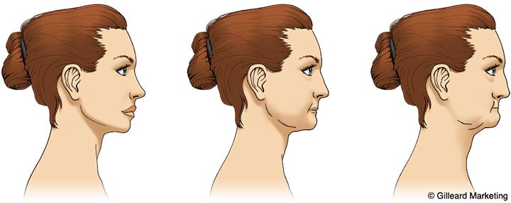 jaw-bone-reduction-horizontal