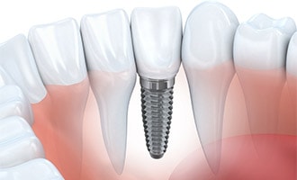 single-implant-near-teeth-jpg