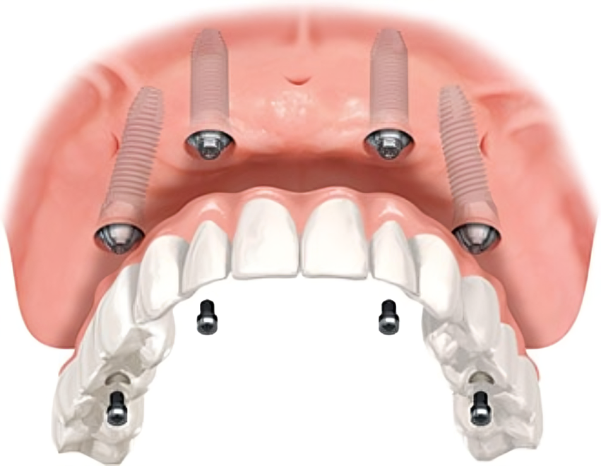All‑on‑4® Dental Implants San Jose CA