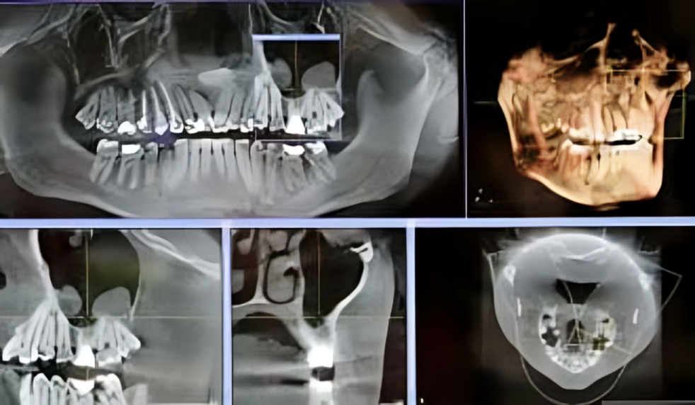 All‑on‑4 Procedure Bay Area