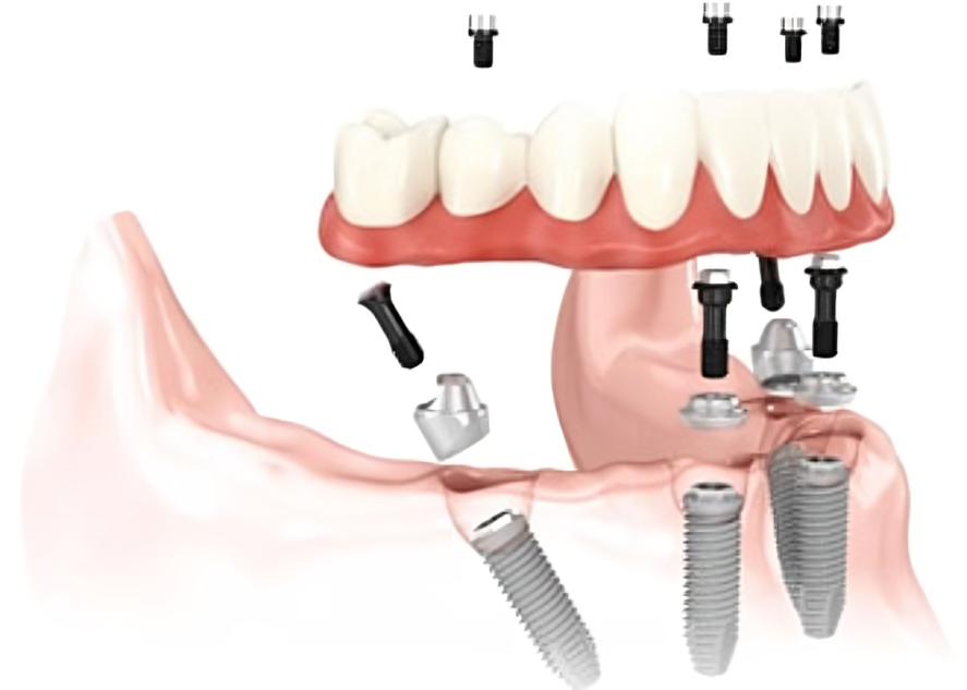 All‑on‑4® Dental Implants Bay Area