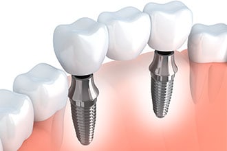 Tooth Replacement Options Bay Area