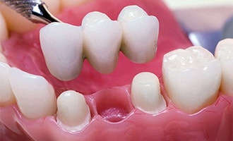 Dental Bridge Bay Area