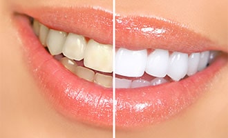 Teeth Whitening San Jose CA