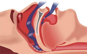 sleepapnea