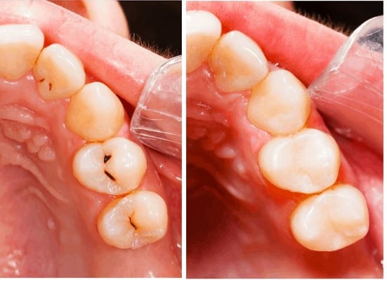 Before and After Tooth-Colored Fillings San Jose CA Before and After Tooth-Colored Fillings San Jose CA
