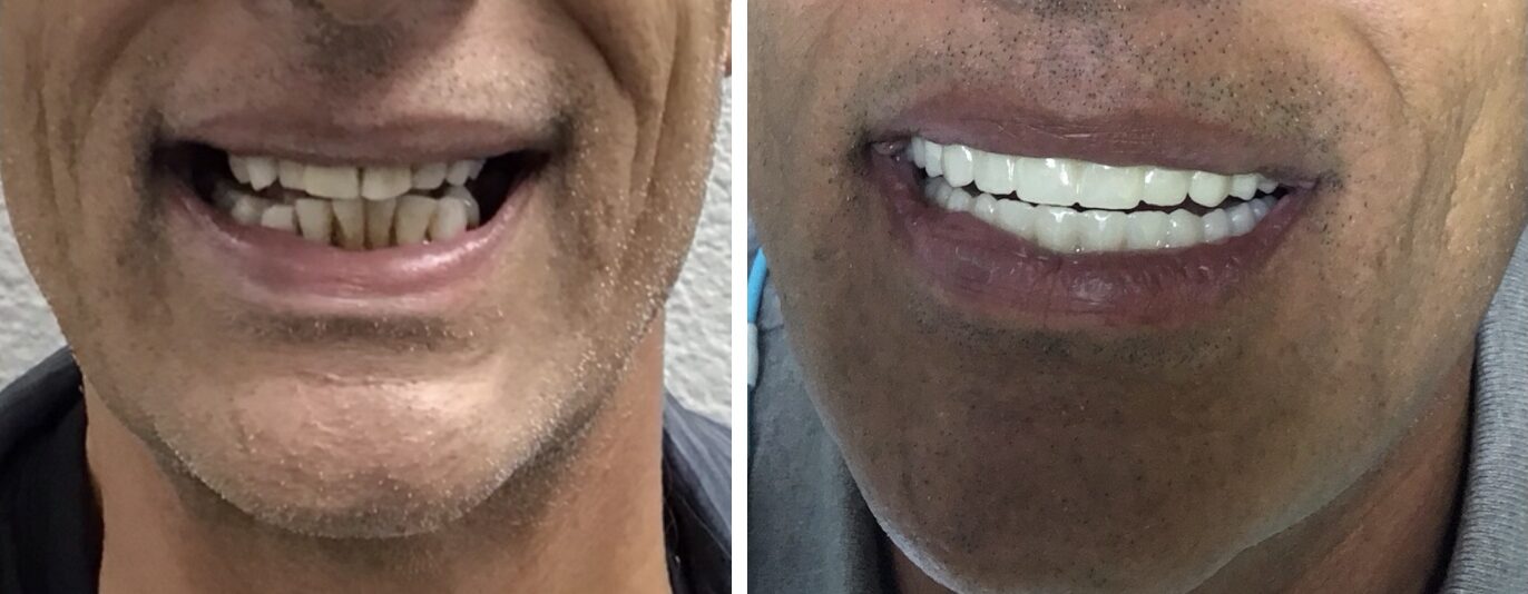 Before and After Image: All On 4 - front