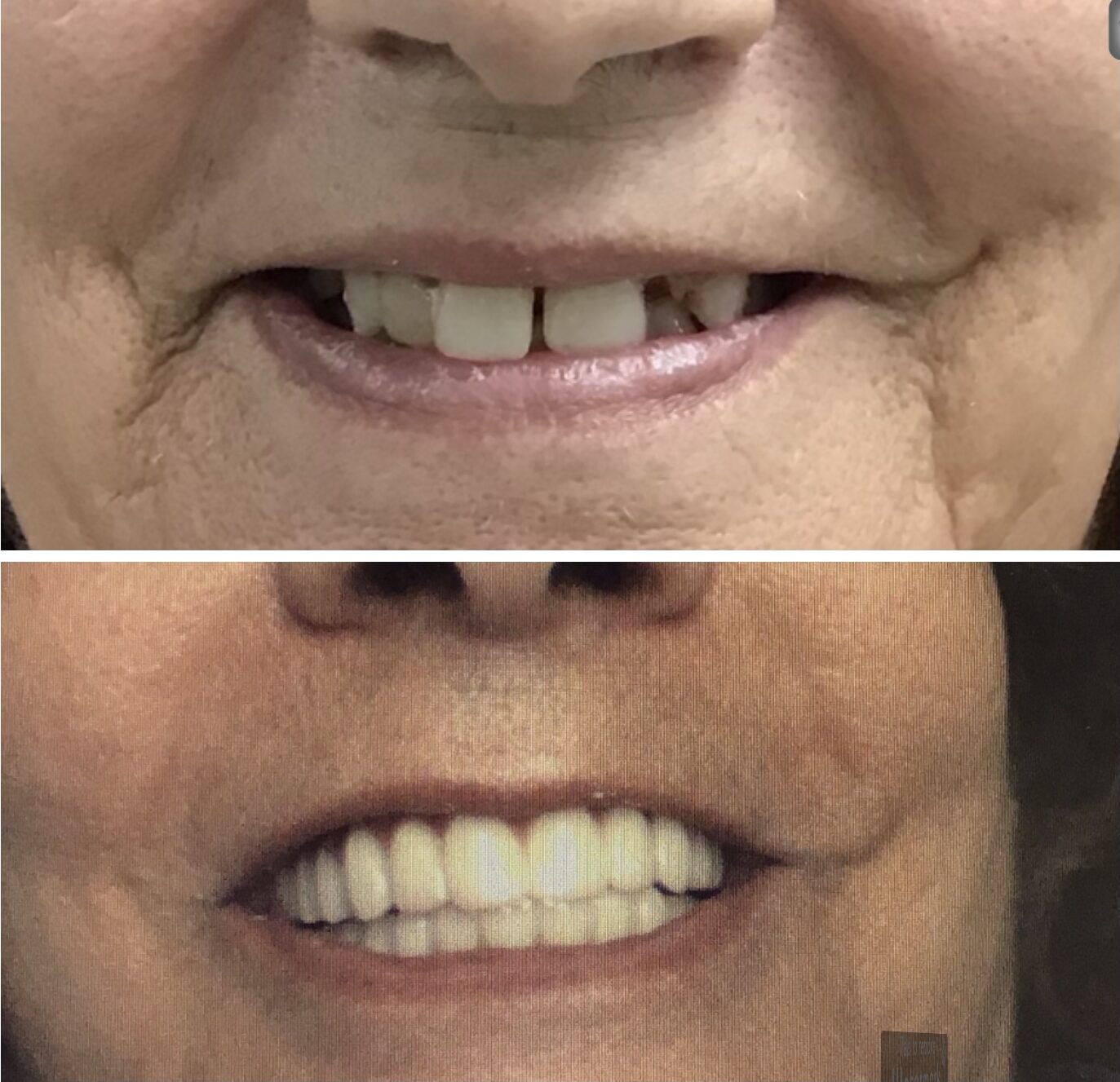 Before and After Image: All On 4 - front