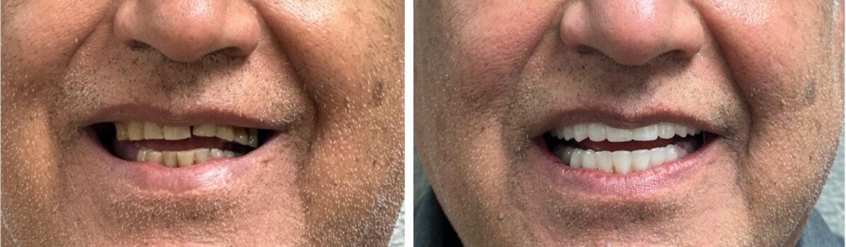 Before and After Image: All On 4 - front