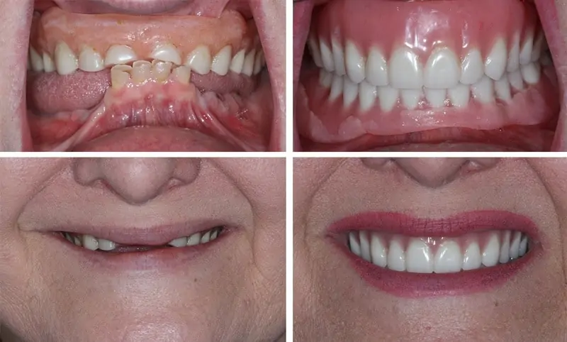 Before and After Image: Immediate Dentures - front