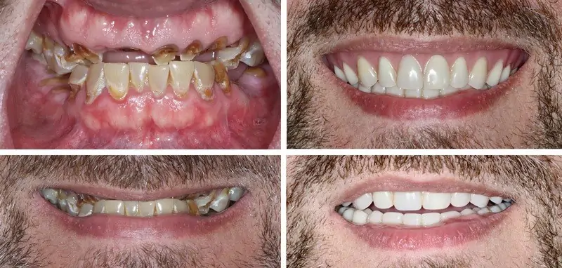 Before and After Image: Immediate Dentures - front