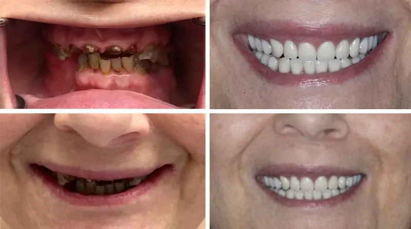 Before and After Image: Immediate Dentures - front