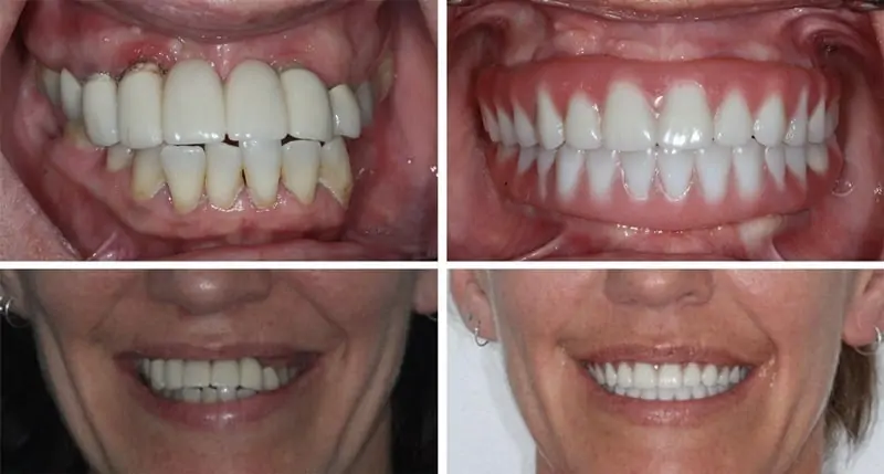 Before and After Image: Implant Supported Dentures - front