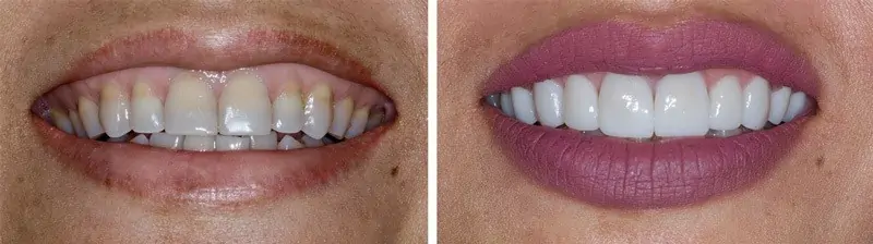 Before and After Image: Porcelain Veneers - front