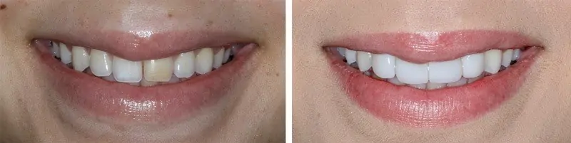 Before and After Image: Porcelain Veneers - front