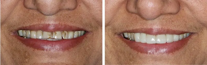 Before and After Image: Porcelain Veneers - front